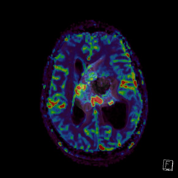 Central neurocytoma (Radiopaedia 84497-99872 Axial Perfusion 132).jpg