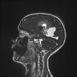 Central neurocytoma (Radiopaedia 84497-99872 Sagittal CISS 66).jpg