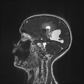 Central neurocytoma (Radiopaedia 84497-99872 Sagittal CISS 67).jpg