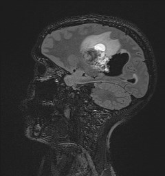 Central neurocytoma (Radiopaedia 84497-99872 Sagittal Flair + Gd 98).jpg