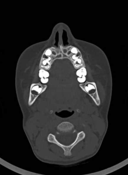 Cerebellar abscess (Radiopaedia 73727-84527 Axial bone window 7).jpg