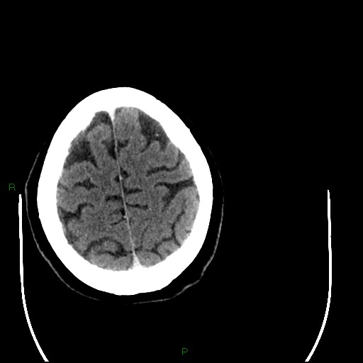 Cerebellar abscess (Radiopaedia 78135-90671 Axial C+ delayed 91).jpg