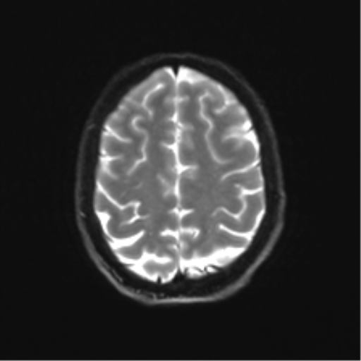 Cerebellar agenesis with hypoplastic pons (pontocerebellar hypoplasia) (Radiopaedia 57224-64138 Axial DWI 30).png