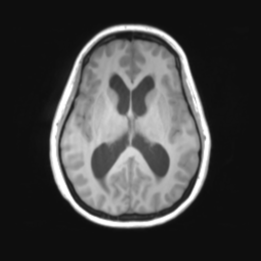 File:Cerebellar ependymoma complicated by post-operative subdural hematoma (Radiopaedia 83322-97736 Axial T1 23).png