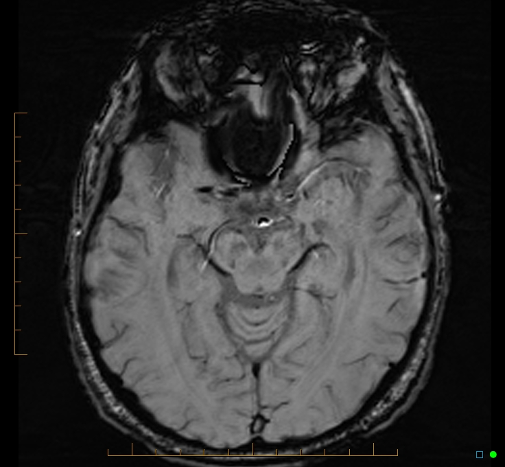 Cerebellar gangliocytoma (Radiopaedia 65377-74422 Axial SWI 23).jpg