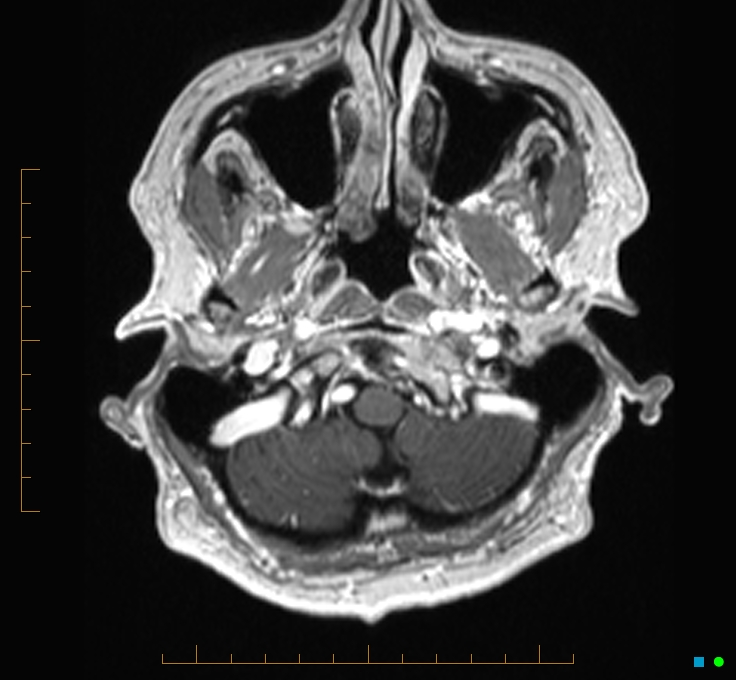 Cerebellar gangliocytoma (Radiopaedia 65377-74422 Axial T1 C+ 3).jpg