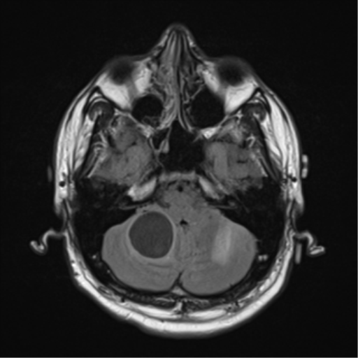 File:Cerebellar hemangioblastomas and pituitary adenoma (Radiopaedia 85490-101176 Axial FLAIR 7).png