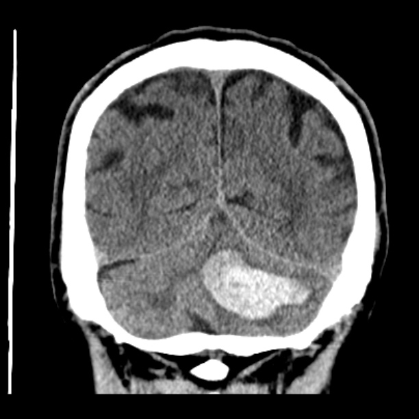 Cerebellar hemorrhage (Radiopaedia 27193-27359 Coronal non-contrast 45).jpg