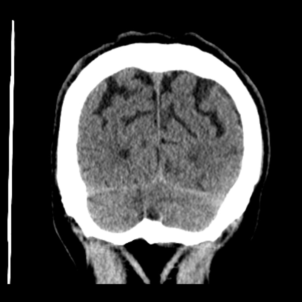 Cerebellar hemorrhage (Radiopaedia 27193-27359 Coronal non-contrast 49).jpg