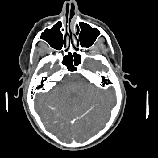 Cerebellar infarct due to vertebral artery dissection with posterior fossa decompression (Radiopaedia 82779-97029 C 9).png