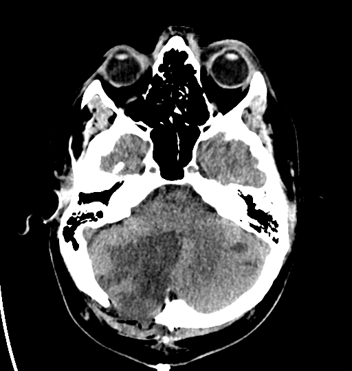 File:Cerebellar infarct due to vertebral artery dissection with posterior fossa decompression (Radiopaedia 82779-97031 Axial non-contrast 8).png