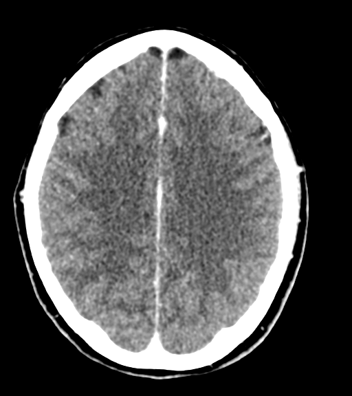 Cerebellar metastases - colorectal adenocarcinoma (Radiopaedia 40947-43652 Axial C+ 42).png