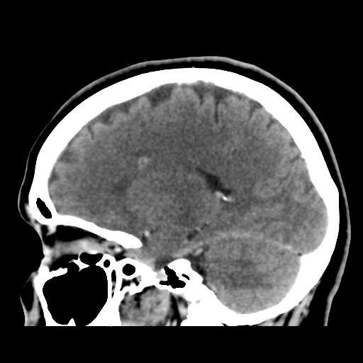 File:Cerebellar metastasis (cystic appearance) (Radiopaedia 41395-44258 F 33).png