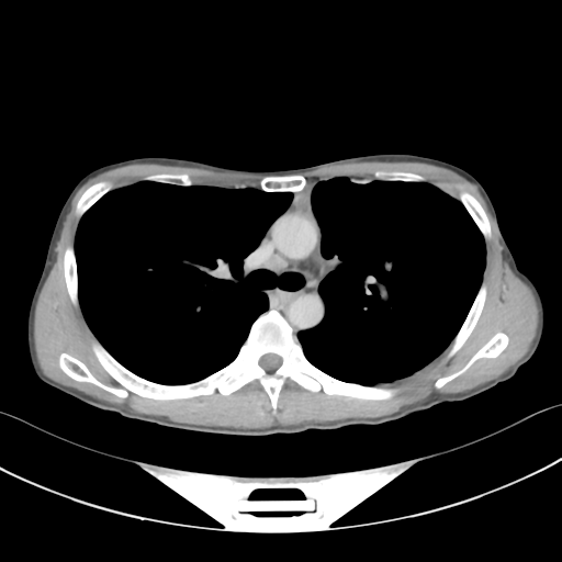 Cerebellar metastasis - adenocarcinoma lung (Radiopaedia 63184-71717 Axial C+ delayed 27).png