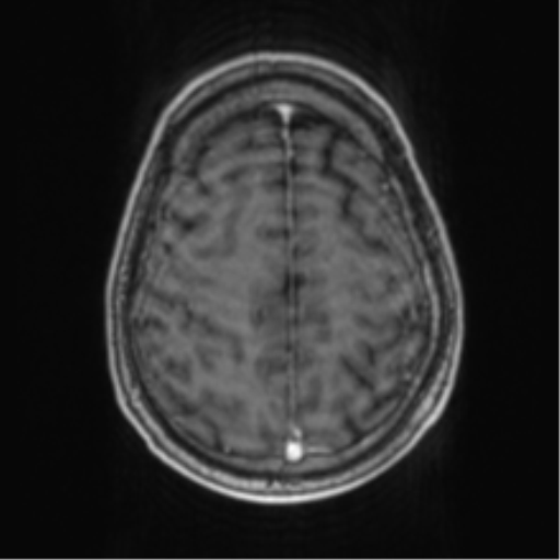 Cerebellar metastasis from lung adenocarcinoma (Radiopaedia 86690-102829 Axial T1 C+ 63).png