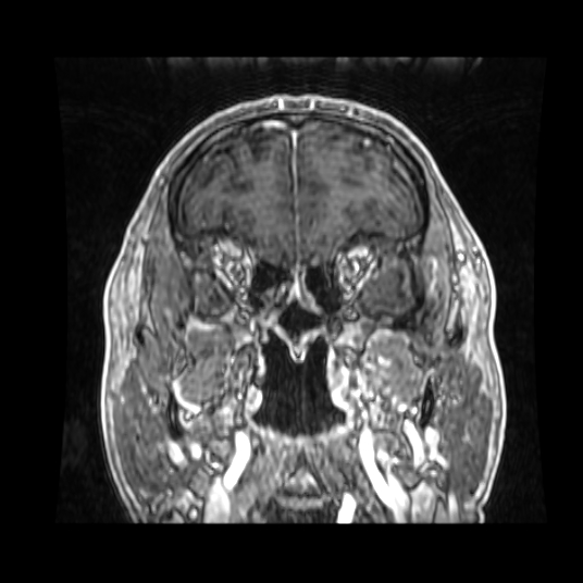 Cerebellar metastasis of pulmonary adenocarcinoma, cavernous venous malformation, and developmental venous anomaly (Radiopaedia 85827-101661 Coronal T1 C+ 73).jpg