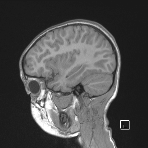 File:Cerebellar stroke (Radiopaedia 32202-33150 Sagittal T1 C+ 39).png