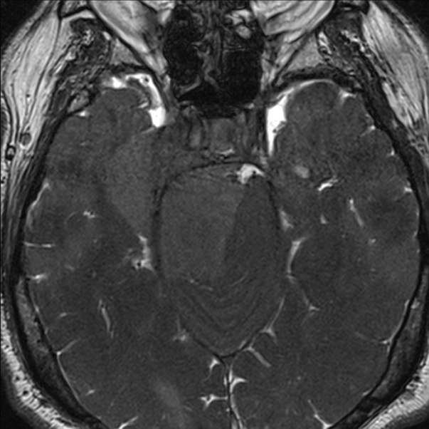 Cerebellopontine angle meningioma (Radiopaedia 24459-24764 I 32).jpg