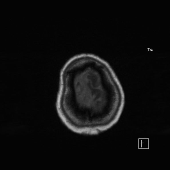 Cerebral abscess (Radiopaedia 26111-26247 Axial T1 51).jpg
