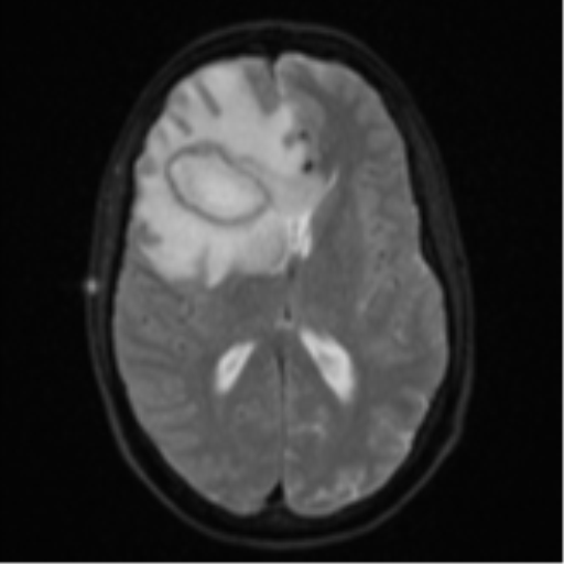 Cerebral abscess (Radiopaedia 60342-68009 Axial DWI 20).png