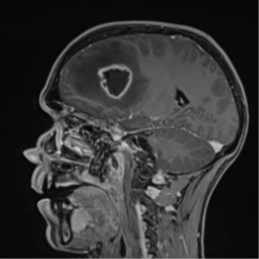 Cerebral abscess (Radiopaedia 60342-68009 J 35).png
