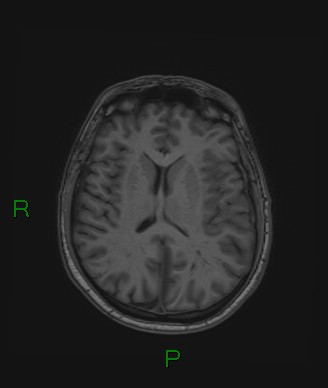 Cerebral abscess and subdural empyema (Radiopaedia 84436-99779 Axial T1 38).jpg
