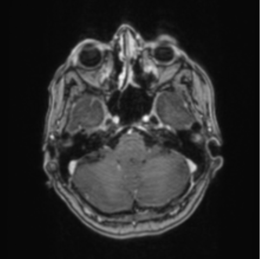 Cerebral abscess from pulmonary arteriovenous malformation (Radiopaedia 86275-102291 Axial T1 C+ 20).png