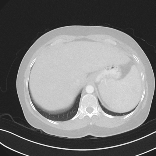 File:Cerebral abscess from pulmonary arteriovenous malformation (Radiopaedia 86275-102292 Axial lung window 52).png