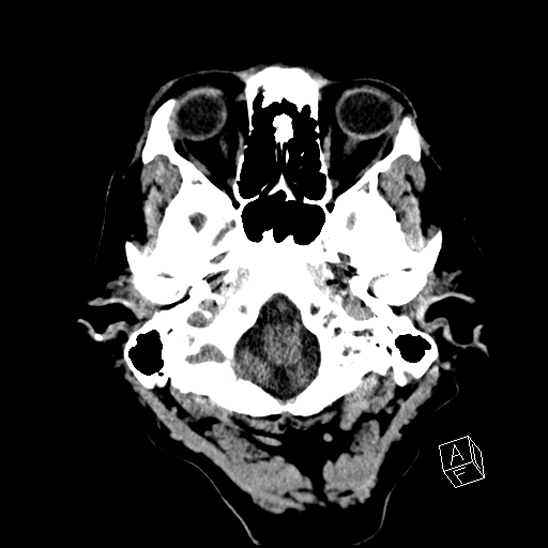 Cerebral abscess with ventriculitis (Radiopaedia 78965-91876 Axial non-contrast 9).jpg