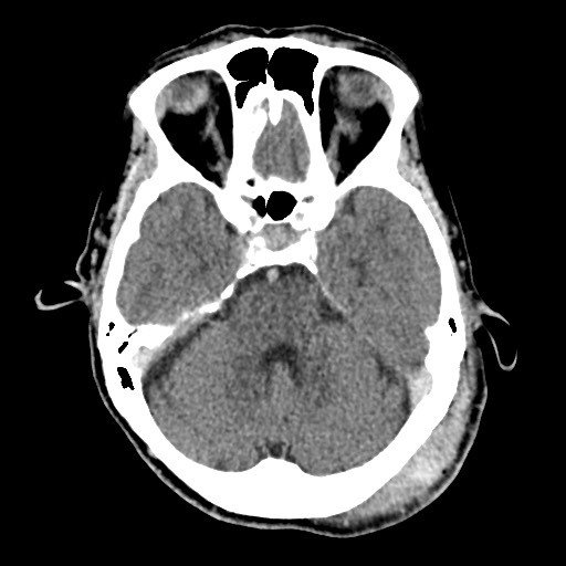 Cerebral amyloid angiopathy-related inflammation (Radiopaedia 74836-85848 Axial non-contrast 21).jpg