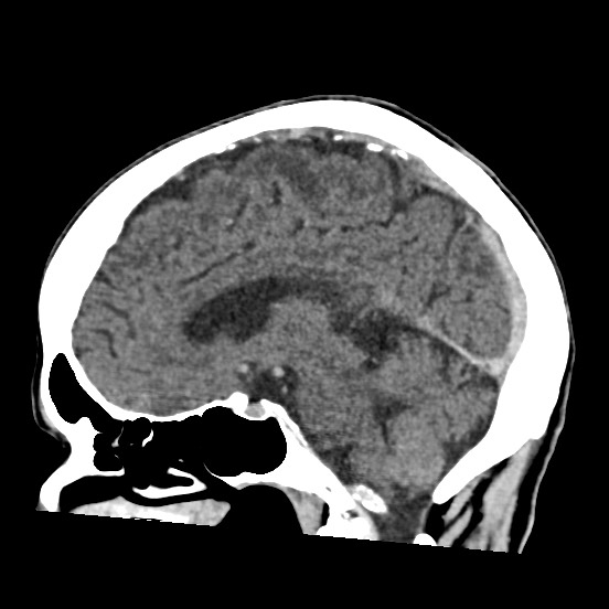 Cerebral amyloid angiopathy-related inflammation (Radiopaedia 74836-85848 C 33).jpg