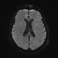 Cerebral amyloid angiopathy-related inflammation (Radiopaedia 74836-85849 Axial DWI 48).jpg