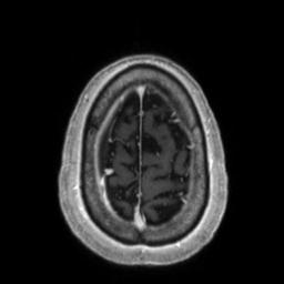 Cerebral amyloid angiopathy (Radiopaedia 29129-29518 Axial T1 C+ 133).jpg