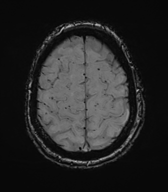 Cerebral amyloid angiopathy (Radiopaedia 46082-50433 Axial SWI 70).png