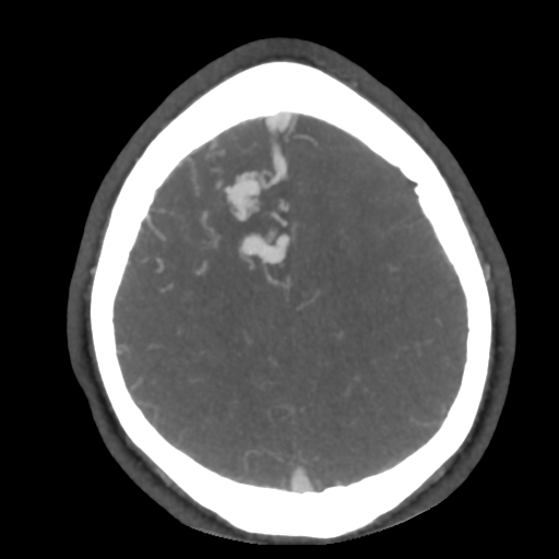 Cerebral arteriovenous malformation (Radiopaedia 39259-41505 AX CEREBRAL CTA 45).png
