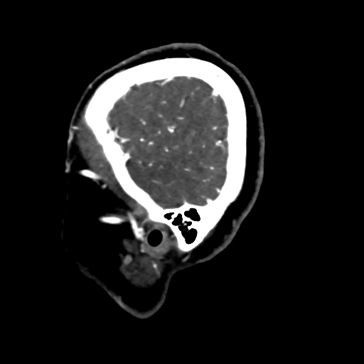 Cerebral arteriovenous malformation (Radiopaedia 73830-84645 Sagittal C+ delayed 9).jpg