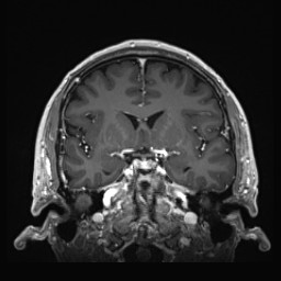 Cerebral arteriovenous malformation (Radiopaedia 84015-99245 Coronal T1 C+ 69).jpg