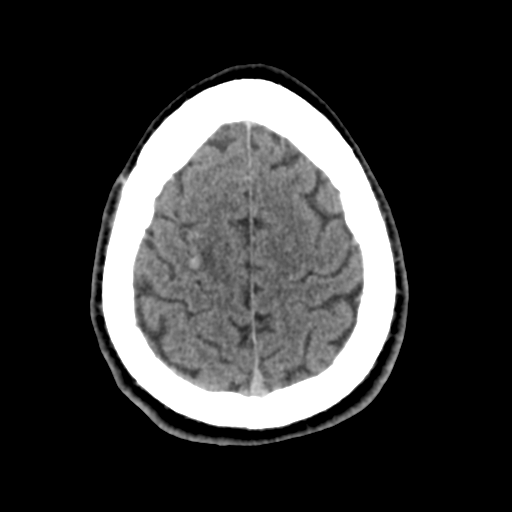 Cerebral arteriovenous malformation (Spetzler-Martin grade 2) (Radiopaedia 41262-44076 Axial non-contrast 46).png