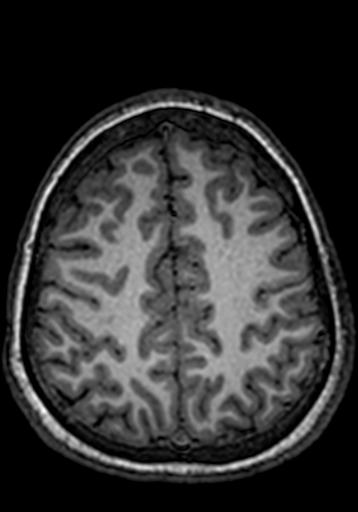 Cerebral arteriovenous malformation at posterior body of corpus callosum (Radiopaedia 74111-84925 Axial T1 63).jpg