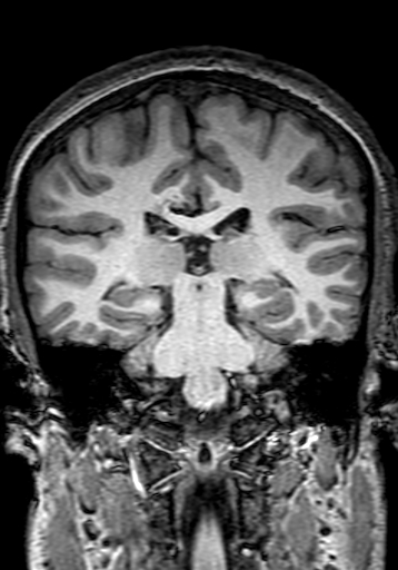 File:Cerebral arteriovenous malformation at posterior body of corpus callosum (Radiopaedia 74111-84925 Coronal T1 202).jpg
