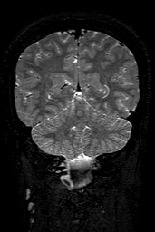 Cerebral arteriovenous malformation at posterior body of corpus callosum (Radiopaedia 74111-84925 Coronal T2 132).jpg