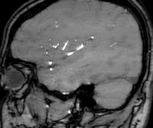 Cerebral arteriovenous malformation at posterior body of corpus callosum (Radiopaedia 74111-84925 J 312).jpg