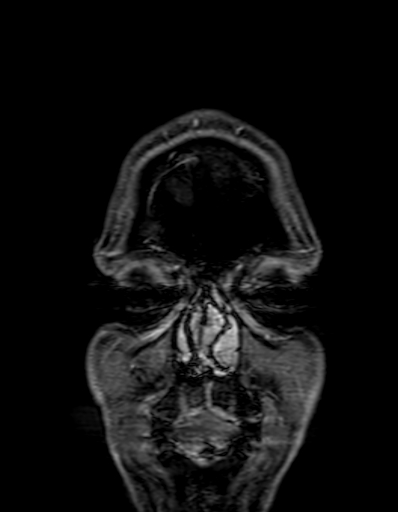 Cerebral arteriovenous malformation at posterior body of corpus callosum (Radiopaedia 74111-84925 K 3).jpg