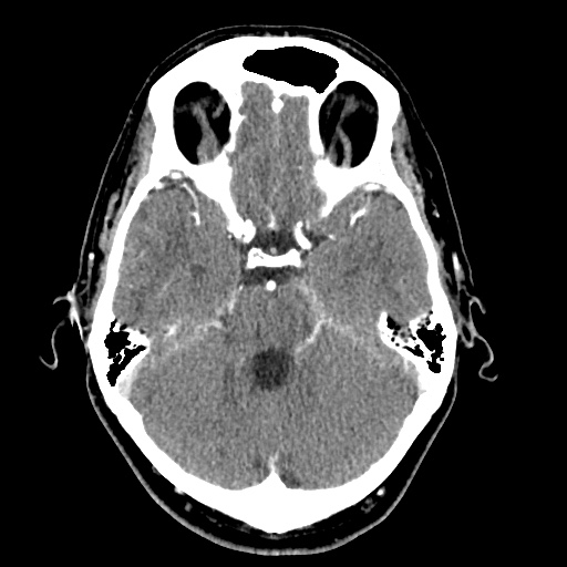 Cerebral arteriovenous malformation with lobar hemorrhage (Radiopaedia 35598-57216 A 19).jpg