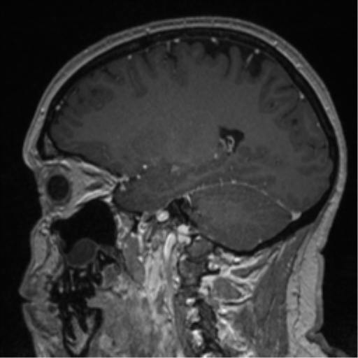 File:Cerebral cavernoma and development venous anomaly (Radiopaedia 37603-39482 Sagittal T1 C+ 36).png