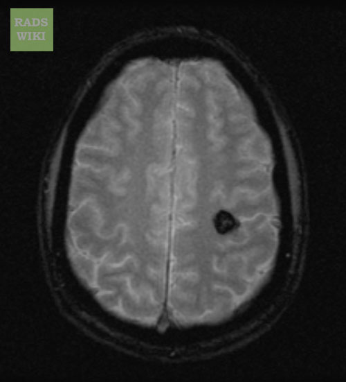 File:Cerebral cavernous malformation (Radiopaedia 11284-11648 Axial 1).jpg