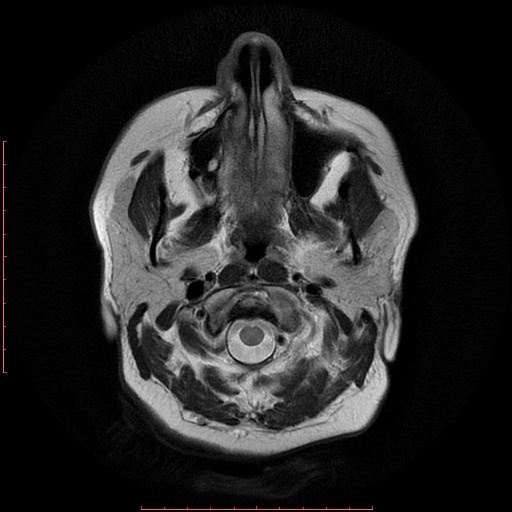 File:Cerebral cavernous malformation (Radiopaedia 26177-26306 Axial T2 2).jpg