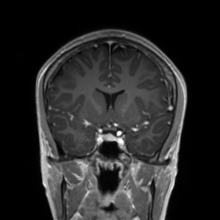 File:Cerebral cavernous venous malformation (Radiopaedia 70008-80021 Coronal T1 C+ 38).jpg