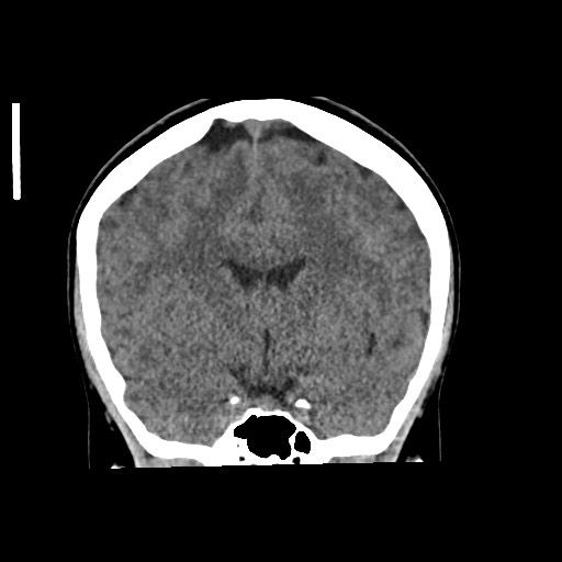 File:Cerebral cavernous venous malformation (Radiopaedia 70008-80022 non-contrast 32).jpg