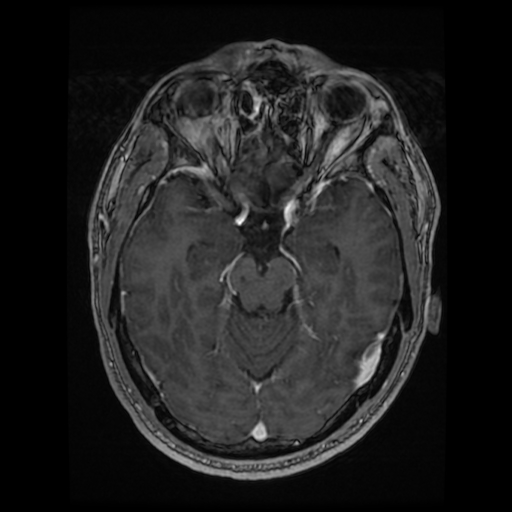 Cerebral cavernous venous malformation (Zabramski type II) (Radiopaedia 85511-101198 Axial T1 C+ fat sat 54).jpg